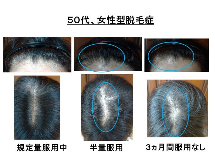 円形脱毛症　病院